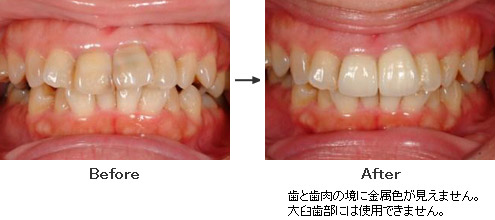 歯と歯肉の境に金属色が見えません。大臼歯部には使用できません。