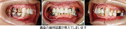 義歯の維持装置が見えてしまいます