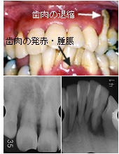 歯周病患者の歯