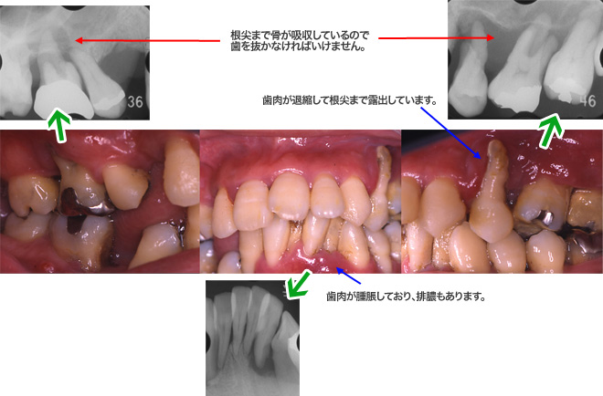 早期発症型歯周炎（侵襲性歯周炎）の写真