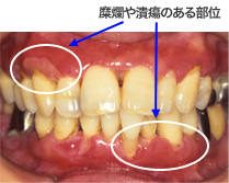 壊死性潰瘍性歯周炎の写真