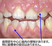 薬物性歯肉増殖症の写真
