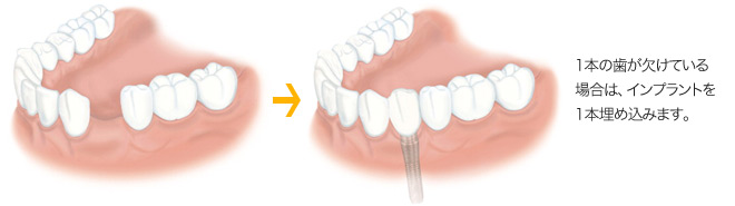1本の歯が欠けている場合は、インプラントを1本埋め込みます。