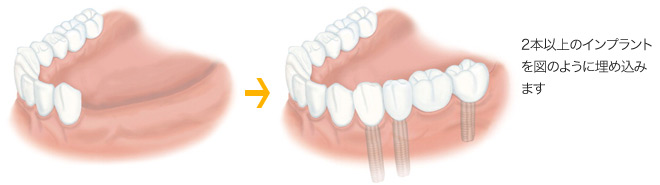 2本以上の歯が欠けている場合は、欠損の程度によって、2本以上のインプラントを1本埋め込みます。
