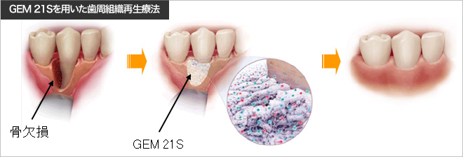EM 21Sを用いた歯周組織再生療法