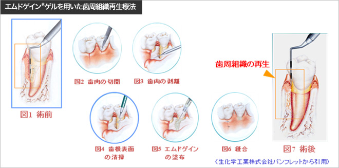 エムドゲイン®ゲルを用いた歯周組織再生療法